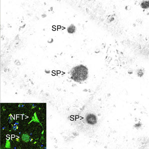 Immunohistochemical analysis of a region of cerebral cortex from an Alzheimer's disease (AD) patient stained with MCA-AB9, the signal detected with a secondary anti-mouse antibody coupled to HRP, signal revealed with DAB. Senile plaques are labeled "SP". The region of the lowest of the three plaques is shown in the inset stained with the fluorescent dye thioflavin-S. This dye binds to not only the senile plaque but also a neurofibrillary tangle (NFT), the other pathological hallmark of AD, which