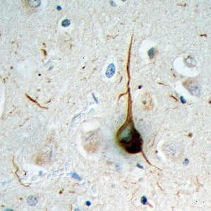 Formalin fixed paraffin embedded section of cerebral cortex of an Alzheimer patient processed with MCA-Ubi-1 using HRP/DAB, giving a brown signal. Also stained with haemotoxylin in blue. A typical flame shaped tangle is seen in a pyramidal neuron in the center and is surrounded by some dystrophic neurites, also strongly ubiquitin positive. Both are commonly seen in cortical and hippocampal Alzheimer brain sections and are typical for this disease, but are rare or absent in healthy brain.